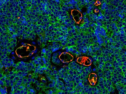 stained Merkel cell carcinoma tumor tissue