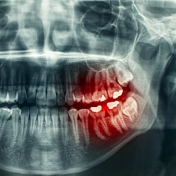 x-ray image of teeth