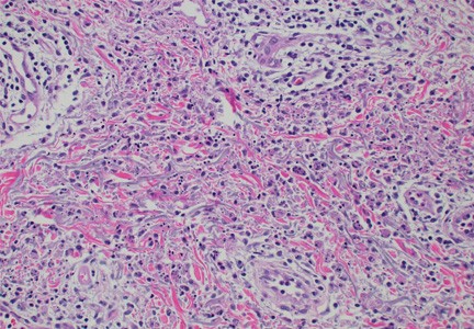 Skin findings in a patient with VEXAS syndrome viewed under a microscope.