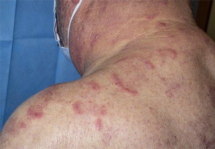 Photo of a person with red marks on their back and shoulder