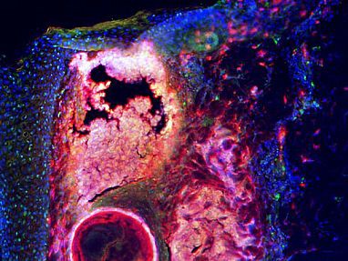 Microscopic image of an inflamed pimple with cathelicidin stained red, fat cells stained green and the nuclei of every cell stained blue.