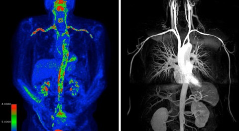 PET scan of a patient showing the vascular system and highlighting areas of inflammation.
