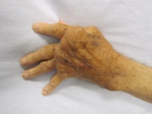 Photo of a hand with rheumatoid arthritis