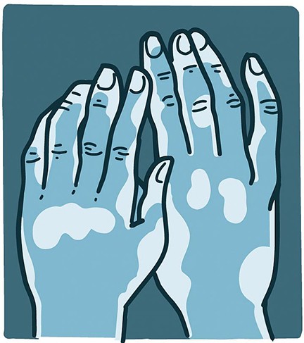 illustration of hands with vitiligo patches visible
