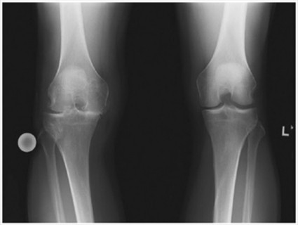 x-ray of knee with osteoarthritis