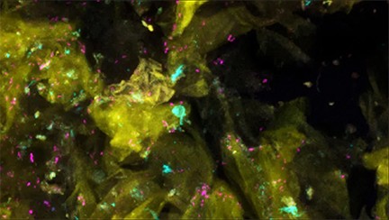 Healthy human skin cells (yellow) are home to bacteria (bright pink), fungi (light blue), and other microorganisms.