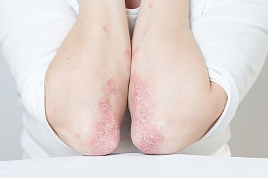 Photo of elbows with psoriasis.