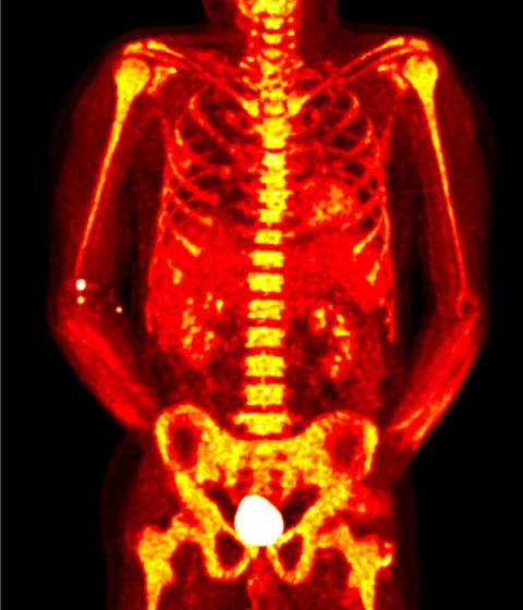 Image of the human plevis, spine and, ribs with the bone marrow highlighted to show extensive inflammation.. 