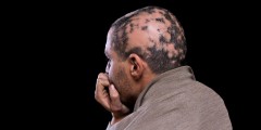 Patient with alopecia