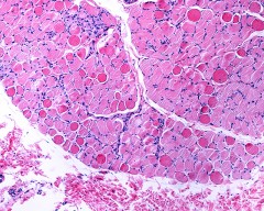 Duchenne dystrophy in muscle fiber