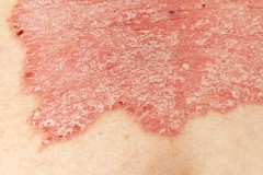 psoriasis