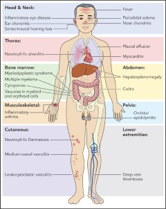 Illustration of a male human body, highlighting the locations of the many possible symptoms of VEXAS.