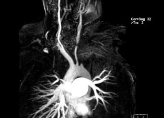MRA scan of patient's upper body