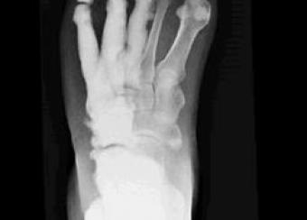 Radiograph of foot showing melorheostosis.