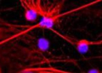 Neutrophil extracellular traps (NETs) in neutrophils isolated from a patient with rheumatoid arthritis following stimulation with recombinant IL-17A in vitro. Exuberant NET formation is observed characterized by long strands of DNA (blue) decorated with the granular protein neutrophil elastase (red).