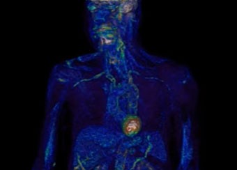 PET Scan of a patient