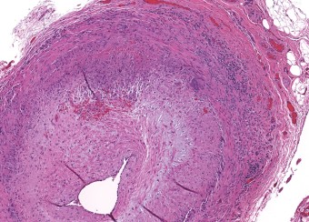 Section through artery