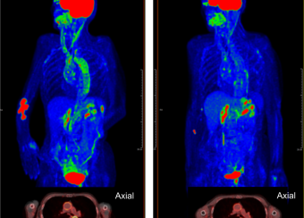 Two body scans showing imflammation