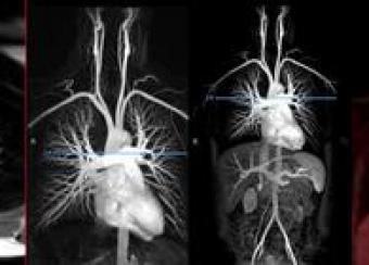 Imaging modalities and sequences are employed to assess vascular inflammation in patients with vasculitis.