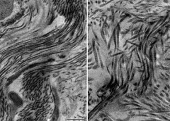 photo showing normal and abnormal scar tissue