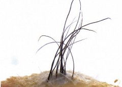 hairy cell
