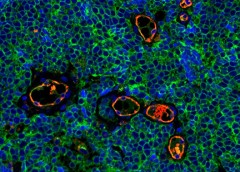 stained Merkel cell carcinoma tumor tissue