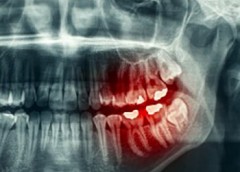 x-ray image of teeth