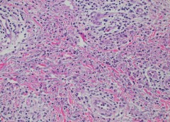 Skin findings in a patient with VEXAS syndrome viewed under a microscope.