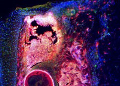 Microscopic image of an inflamed pimple with cathelicidin stained red, fat cells stained green and the nuclei of every cell stained blue.