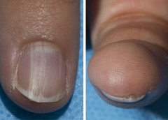 Photo showing nail abnormalities in finger nail
