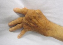 Photo of a hand with rheumatoid arthritis
