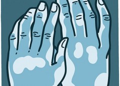 illustration of hands with vitiligo patches visible