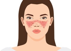 Illustration of a woman with a butterfly rash across her face, covering her nose and cheeks