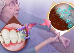 Illustration showing connection between oral bacteria and rheumatoid arthritis