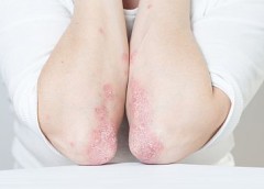 Photo of elbows with psoriasis.